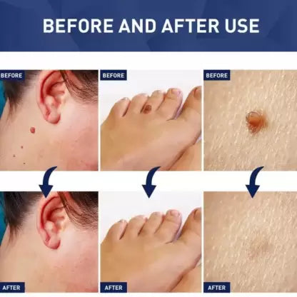 Wart Instant Blemish Cream