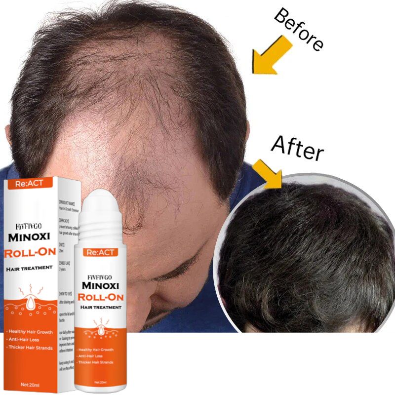 Fivfivgo™ ACT Minoxi Roll-On Hair treatment