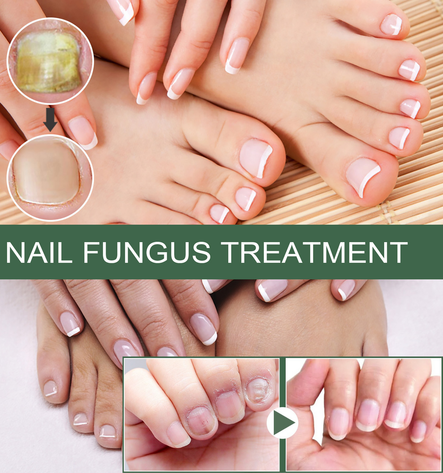 Nail Fungus Solution