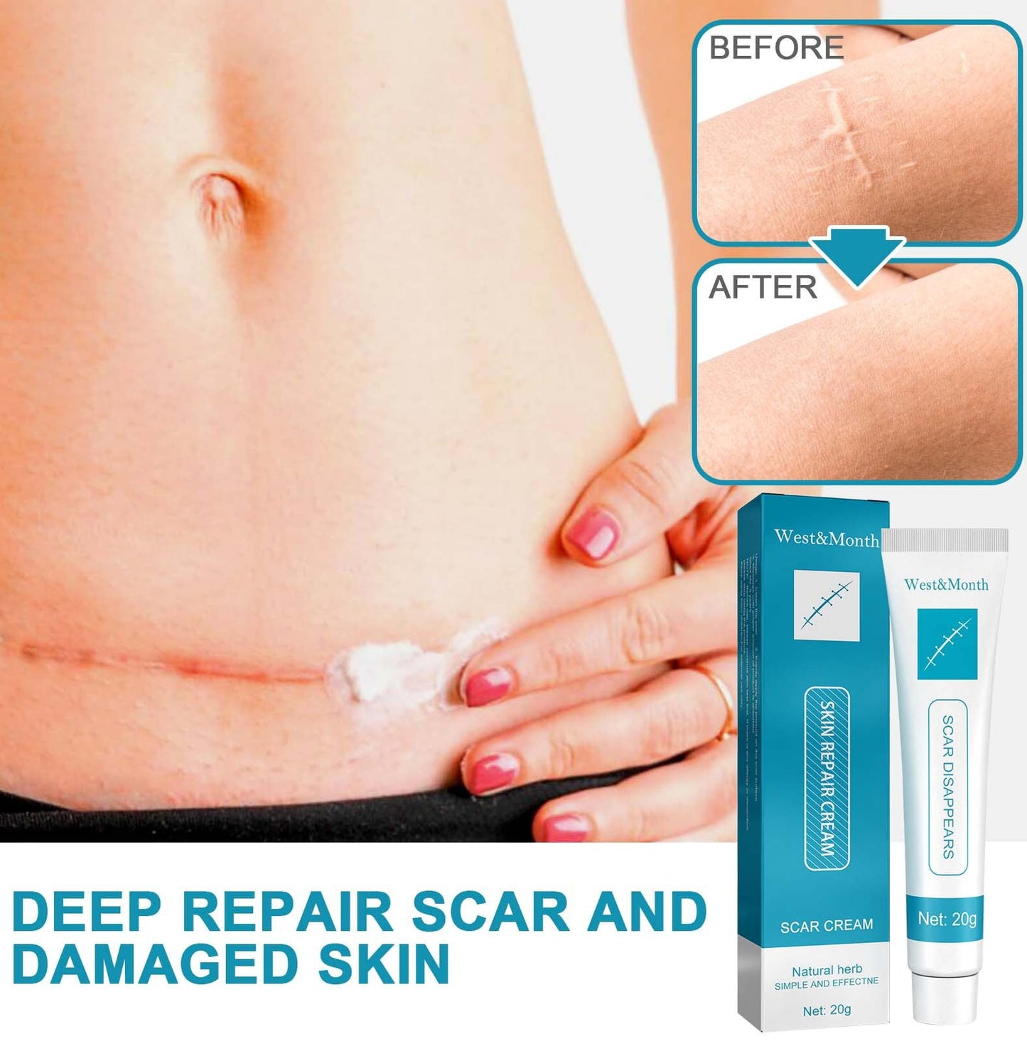 Acne Marks, Scars & Bumps Removal Creams