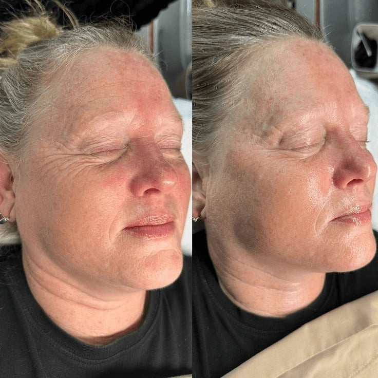 Botox Solution – Smooth, Firm, and Rejuvenate Without Injections