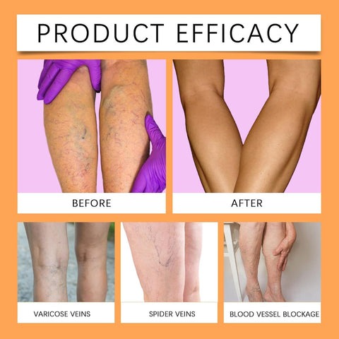 VeinPatch – Natural Relief for Varicose Veins & Tired Legs