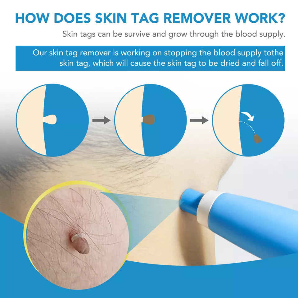 Auto Skin Tag Rapid Removal Kit