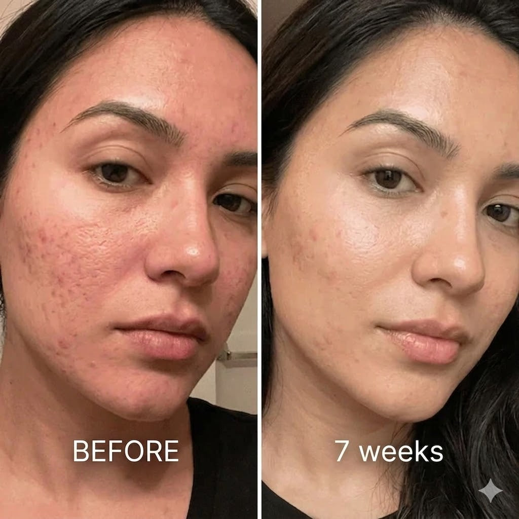 Acne Scar Repair Stick – Targeted Spot Treatment for Smooth Skin