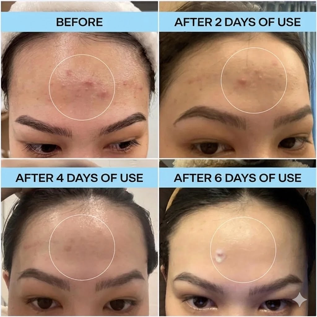 Cafuné Acne Spot Gel – Fade Acne Marks & Control Breakouts