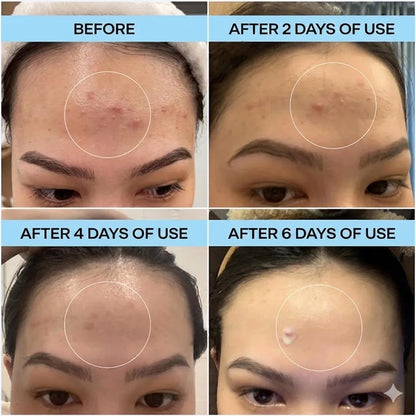 Cafuné Acne Spot Gel – Fade Acne Marks & Control Breakouts
