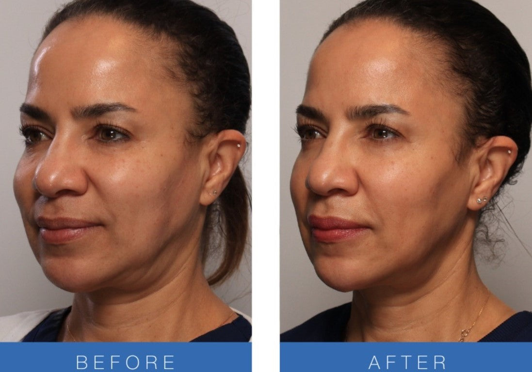 Fivfivgo™ UltraRenew Ultrasonic Facelift Device