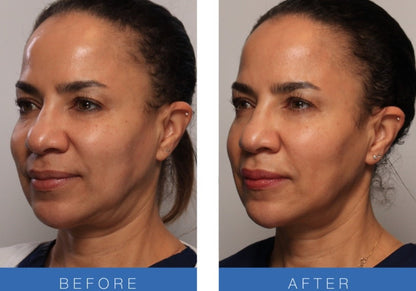 Fivfivgo™ UltraRenew Ultrasonic Facelift Device