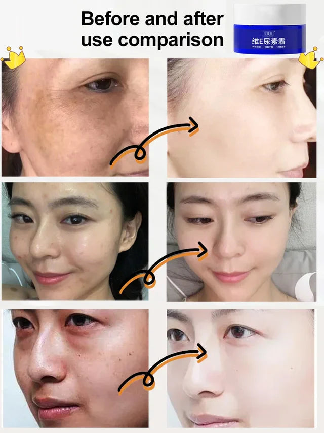 Spot Fading Urea Cream - JAPAN