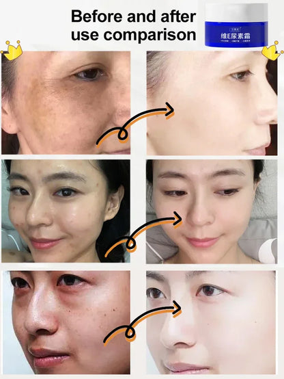 Spot Fading Urea Cream - JAPAN