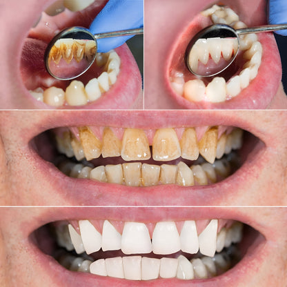 Ultrasonic Tooth Scaler & Electric Toothbrush – 6 Modes with DuPont Brush Head