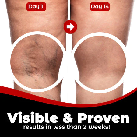 VeinPatch – Natural Relief for Varicose Veins & Tired Legs
