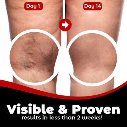 VeinPatch – Natural Relief for Varicose Veins & Tired Legs