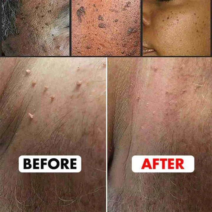 Wart Instant Blemish Cream