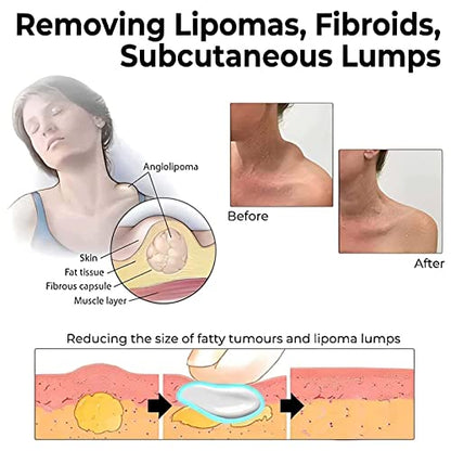 Lipoma Removal Cream