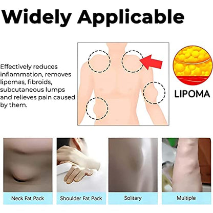 Lipoma Removal Cream