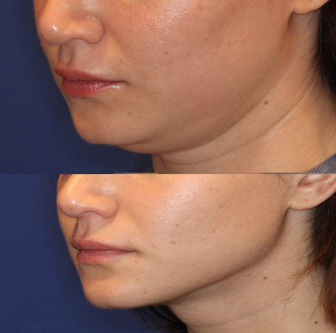 Reusable V Line Face Lifting Mask – Double Chin Shaping Strap