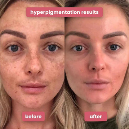 Exfoliating Turmeric Kojic acid pads - Reveal Your Radiant Skin