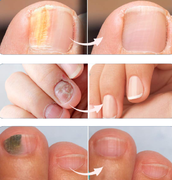 NailGro™ Intense Nail Growth and Strengthening Serum