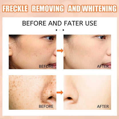 Fivfivgo® TripleAction Vitamin C Freckle Removal Cream