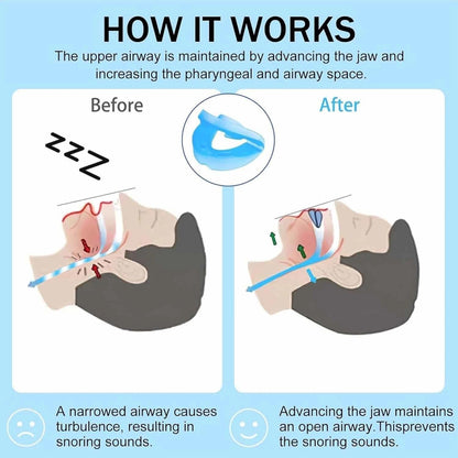 Anti-Snoring Mouthpiece – Sleep Aid Mouth Guard for Quiet Nights