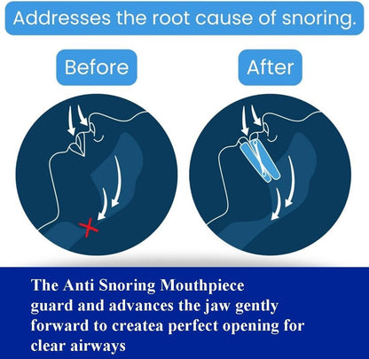 Anti-Snoring Mouthpiece – Sleep Aid Mouth Guard for Quiet Nights