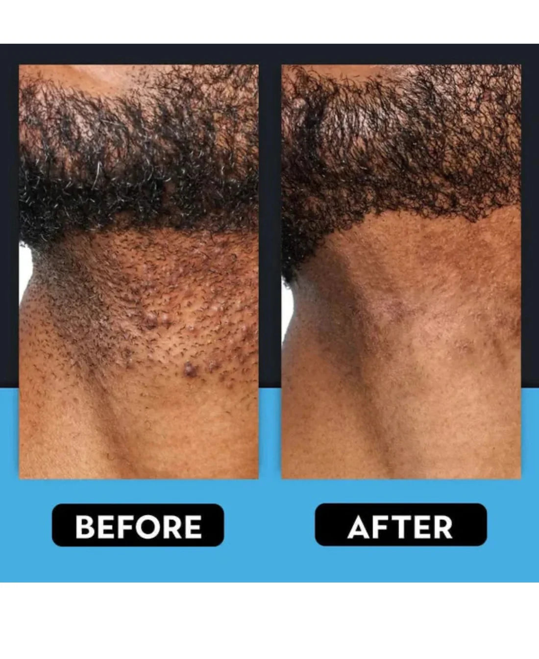 Ingrown Hair Treatment – Soothe, Clear & Prevent Razor Bumps