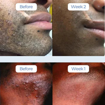 Ingrown Hair Treatment – Soothe, Clear & Prevent Razor Bumps