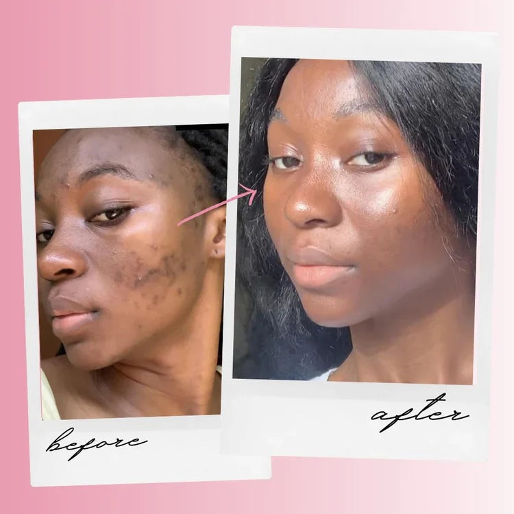 Exfoliating Turmeric Kojic acid pads - Reveal Your Radiant Skin