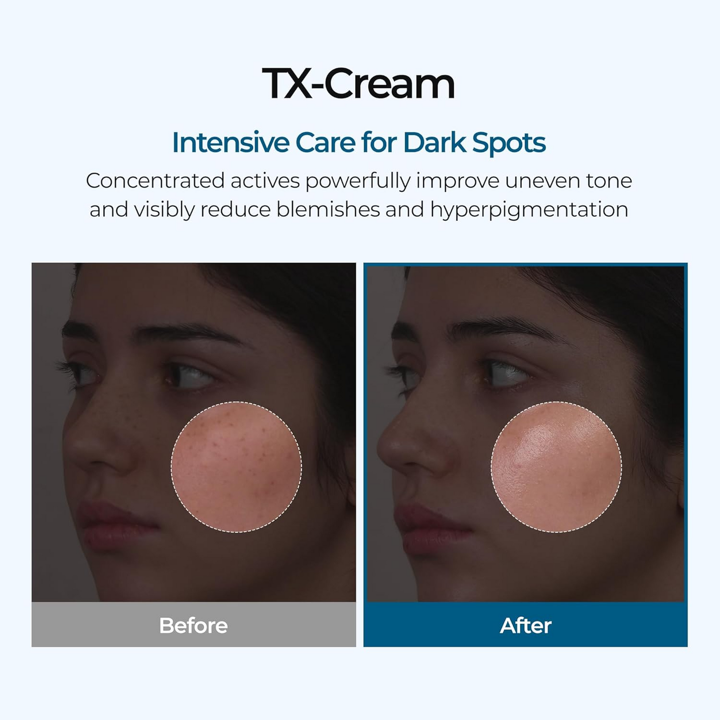 TX Skin Freckle Cream – Korean Dark Spot & Hyperpigmentation Care