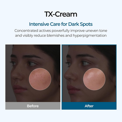 TX Skin Freckle Cream – Korean Dark Spot & Hyperpigmentation Care