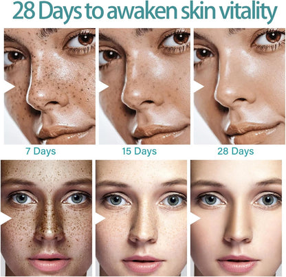 Spot Cream Melasma Remover – 30g Dark Spot & Freckle Corrector