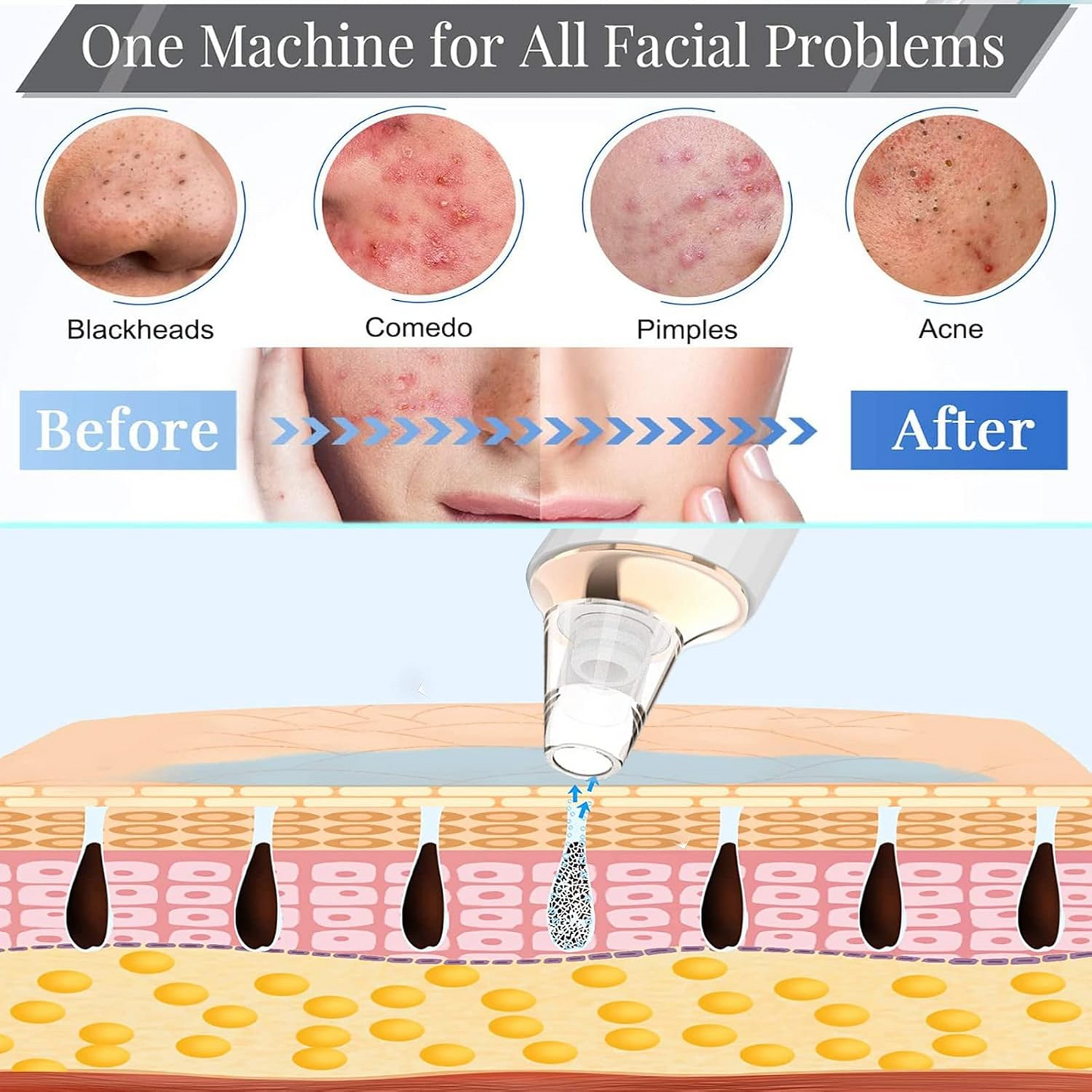 Blackhead Remover Pore Vacuum – USB Facial Pore Cleaning & Suction Device