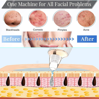 Blackhead Remover Pore Vacuum – USB Facial Pore Cleaning & Suction Device