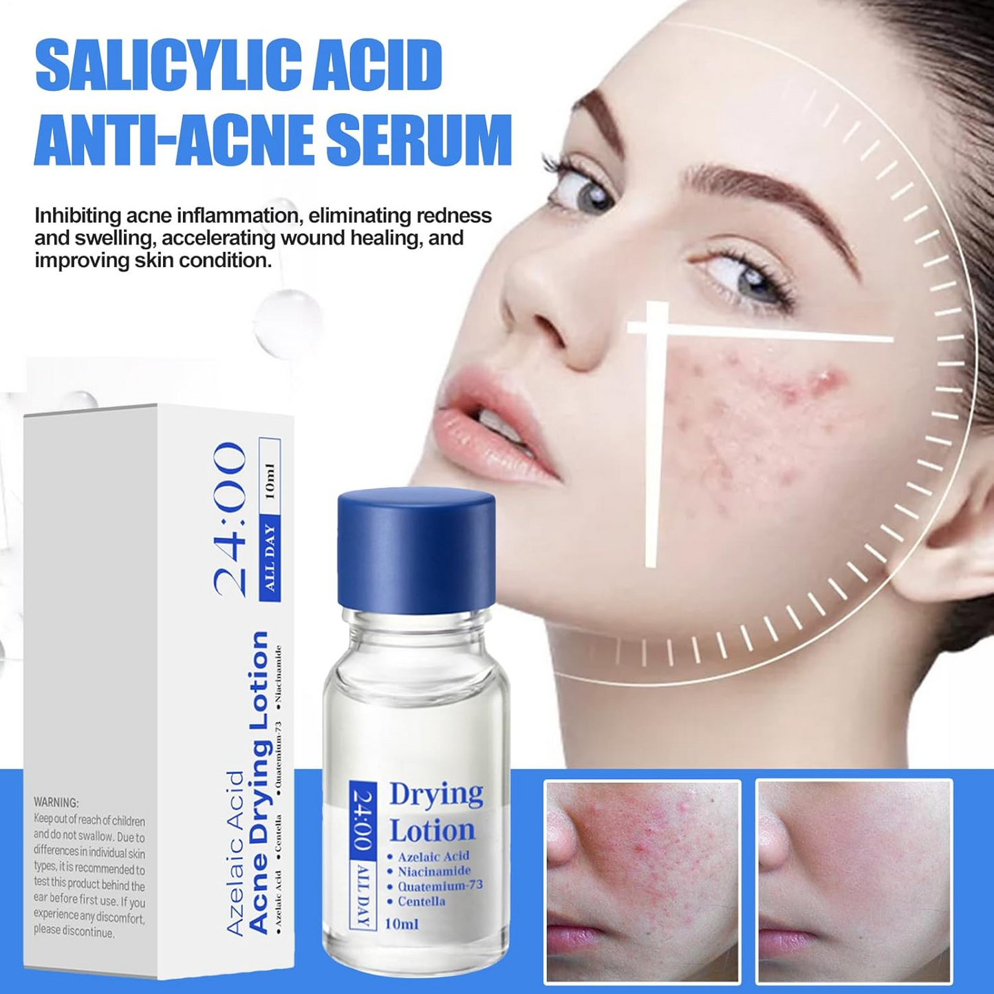 Salicylic Acid Spot Drying Lotion – Targeted Acne Care