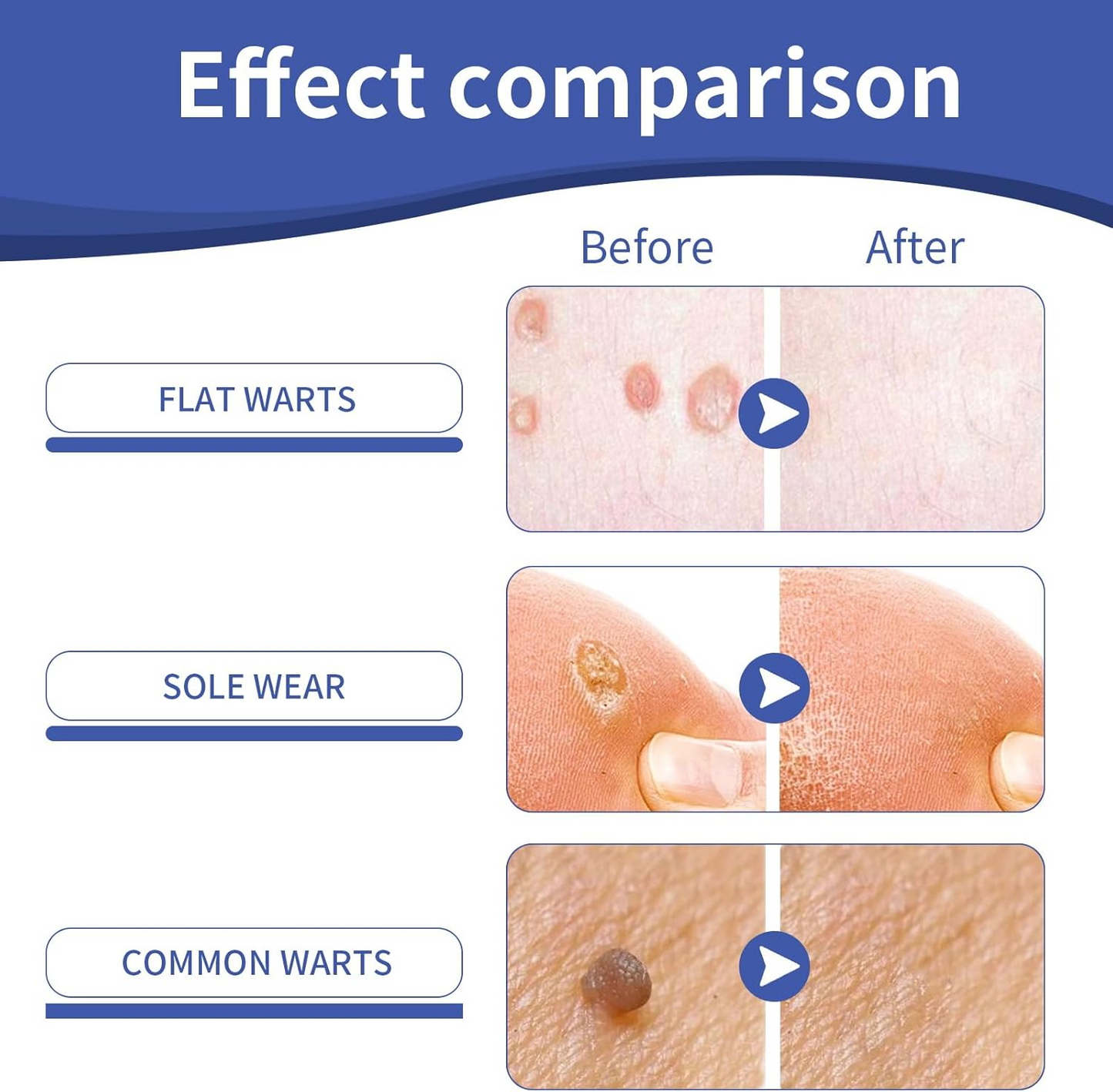 Skin Tag & Wart Remover Cream – Targeted Care for Smooth Skin