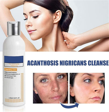 Cleansing Lotion for Acne & Pimples & Acanthosis Nigricans
