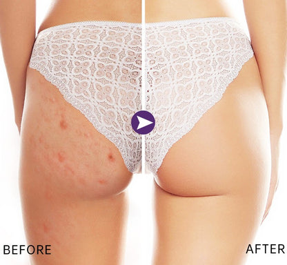 Bootieful™ Butt Treatment Cream