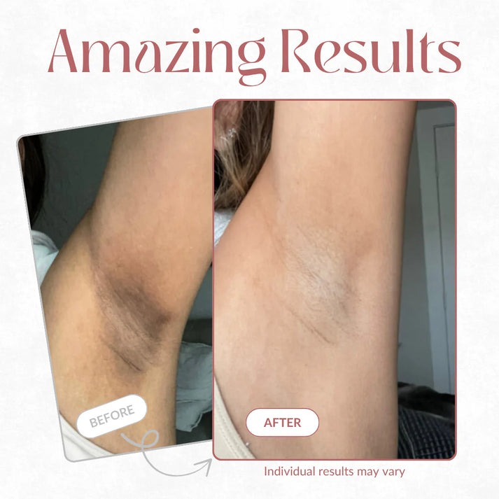 Peel Shot — Kojic + Turmeric Body Peel Spray