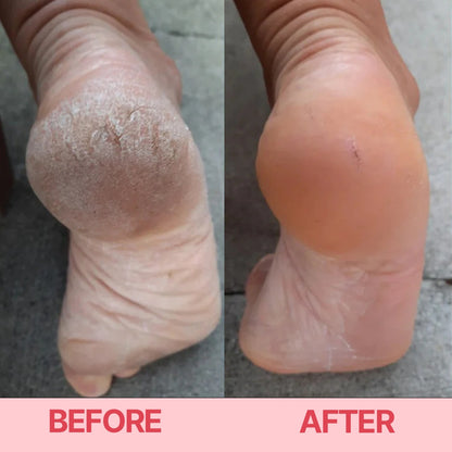 🔋Rechargeable Electric Callus Remover