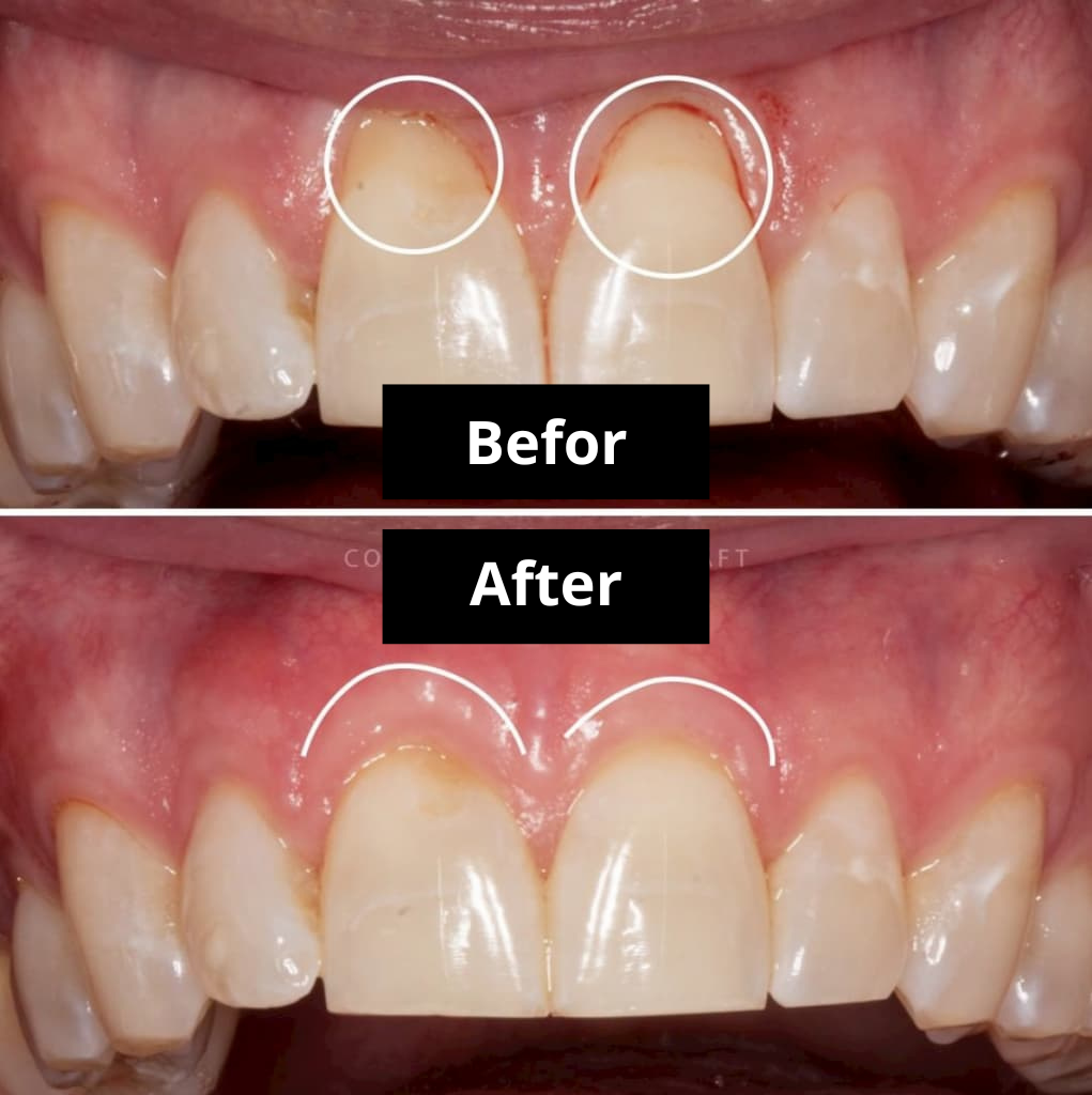 DentiZen™ Gum Therapy Gel