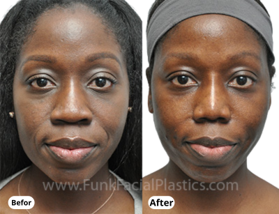 LiftX™ Nose Defining Serum