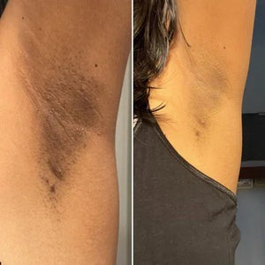 Peel Shot — Kojic + Turmeric Body Peel Spray