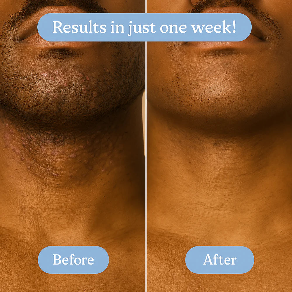 Ingrown Hair Treatment – Soothe, Clear & Prevent Razor Bumps