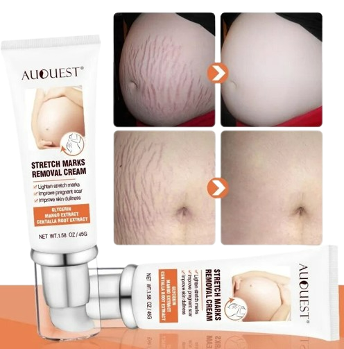 DERMEASE™ Stretchmarks Removal Cream