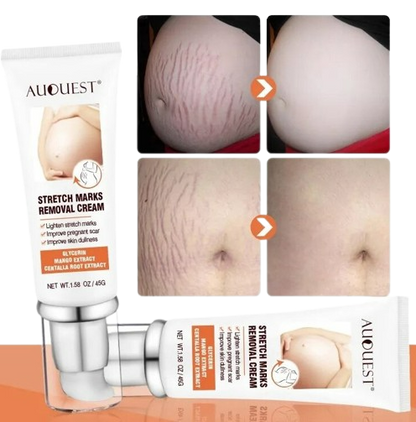 DERMEASE™ Stretchmarks Removal Cream