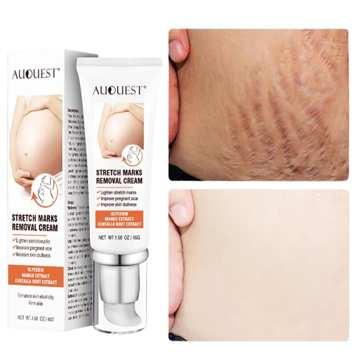 DERMEASE™ Stretchmarks Removal Cream