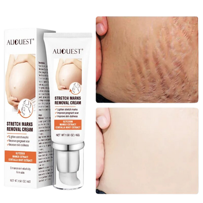 DERMEASE™ Stretchmarks Removal Cream