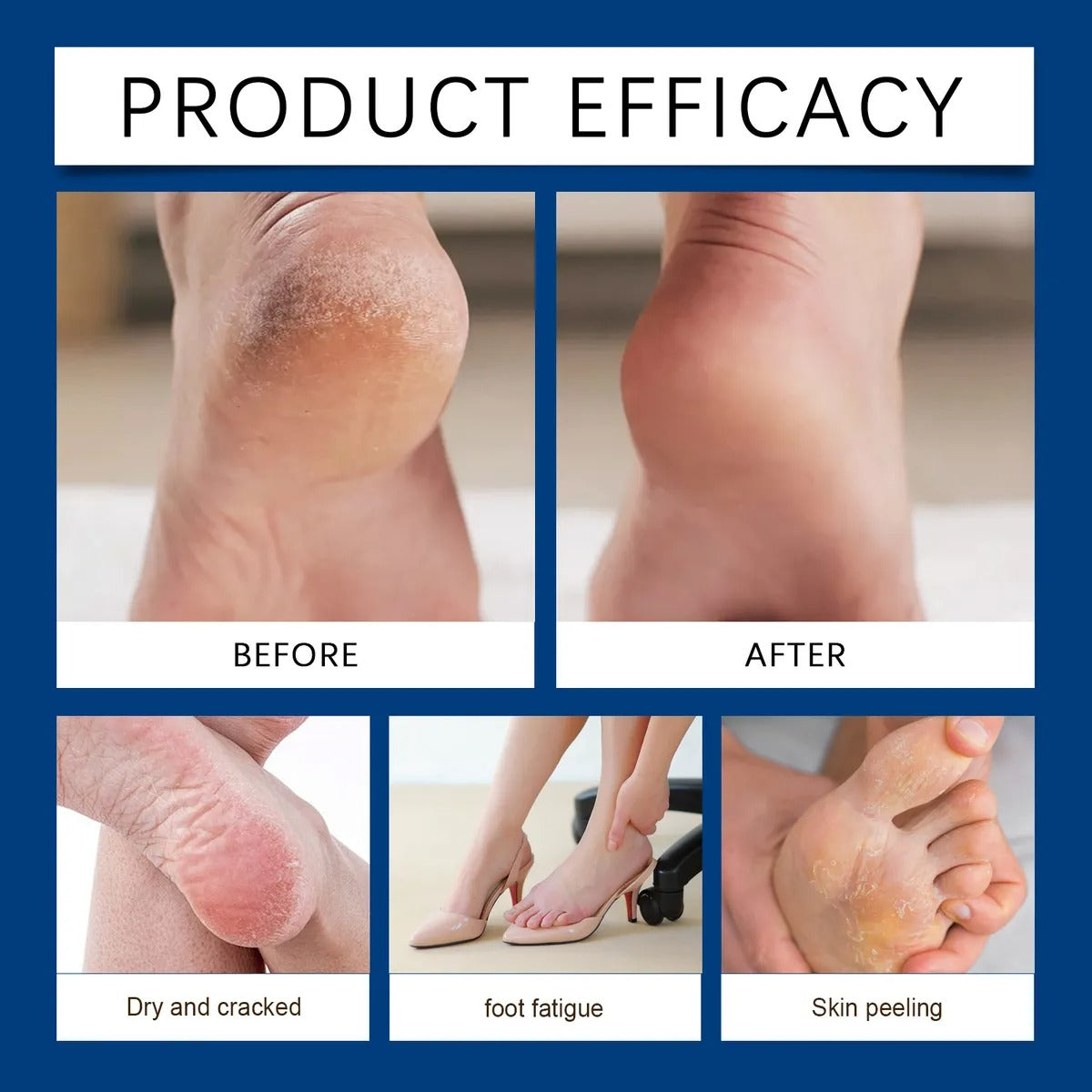 Exfoliating Urea Foot Cream – Deep Repair & Softening Foot Care