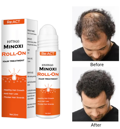 Fivfivgo™ ACT Minoxi Roll-On Hair treatment
